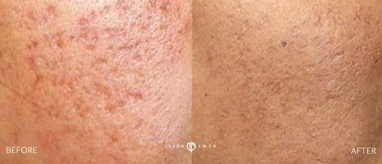 ACNE SCAR TREATMENT GALLERY 09