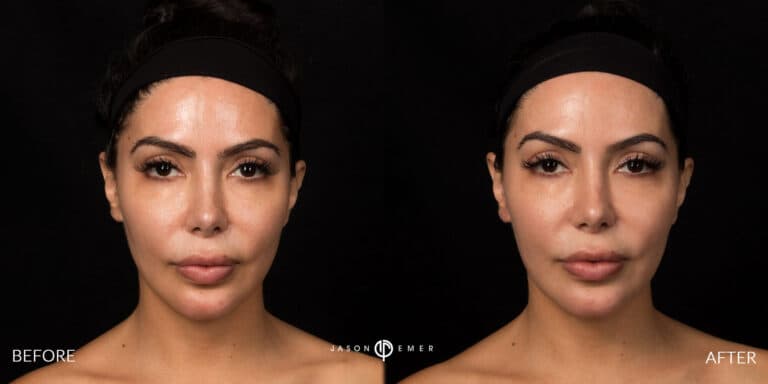 FACIAL SCULPTING FEMALE GALLERY 05
