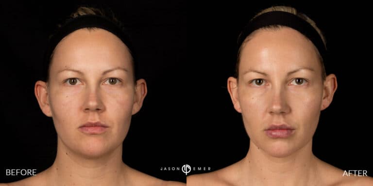 FACIAL SCULPTING FEMALE GALLERY 06