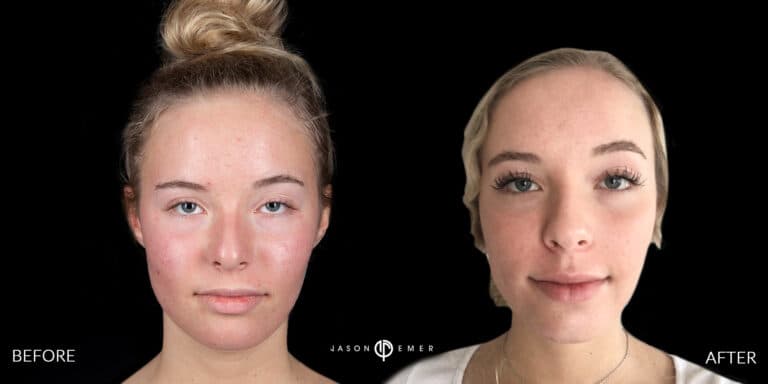 ACNE SCAR TREATMENT GALLERY 02