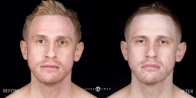 ACNE SCAR TREATMENT GALLERY 07