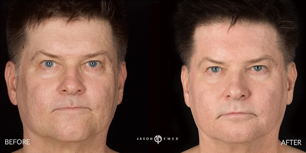 Acne Scars Treatment