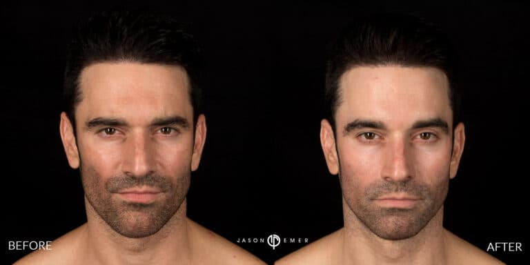 CHEMICAL PEELS GALLERY 21
