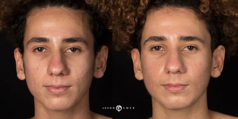 LASER SKIN RESURFACING GALLERY 02