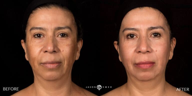 MELASMA GALLERY 02