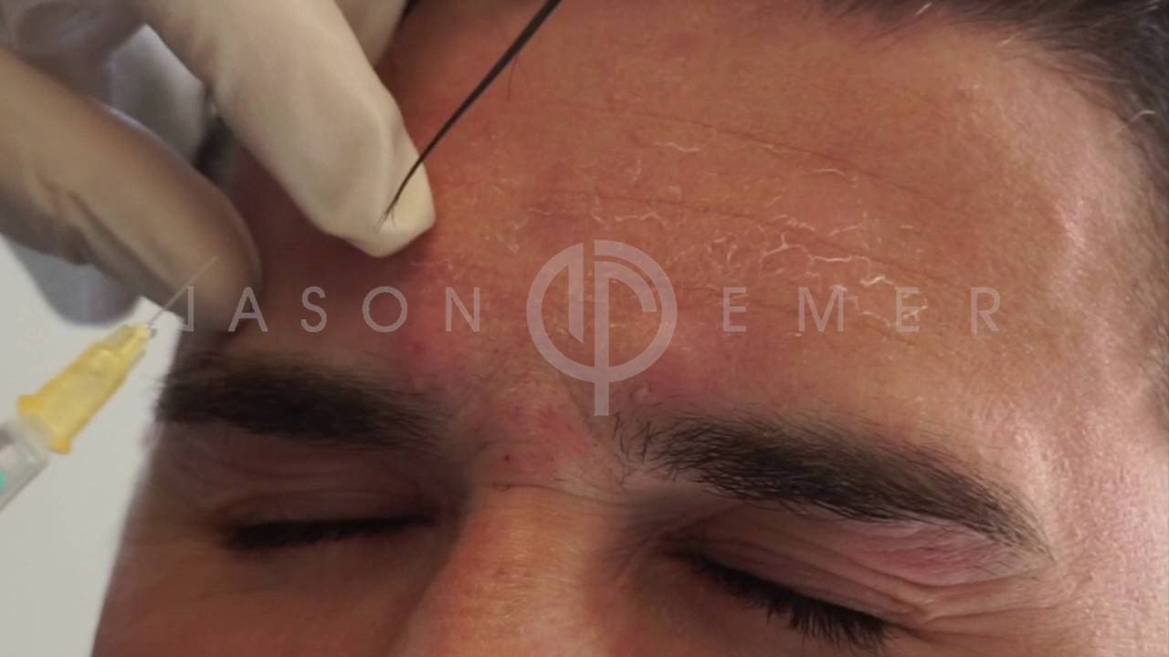 Watch a facetite and accutite procedure video
