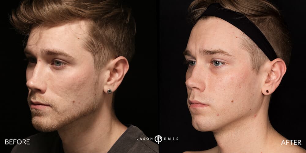 Acne scar best before and after los angeles beverly hills