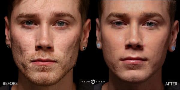 microneedling