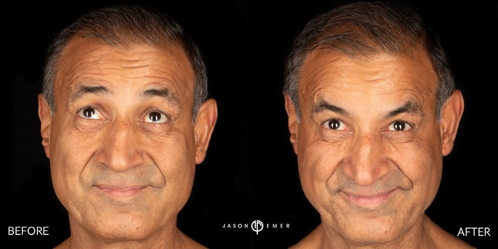 Botox