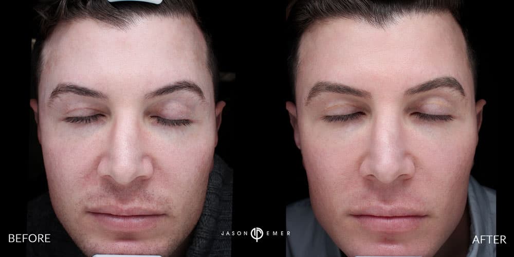 Male-Acne-Scar-Treatment-Before-and-After-Los-Angeles-3