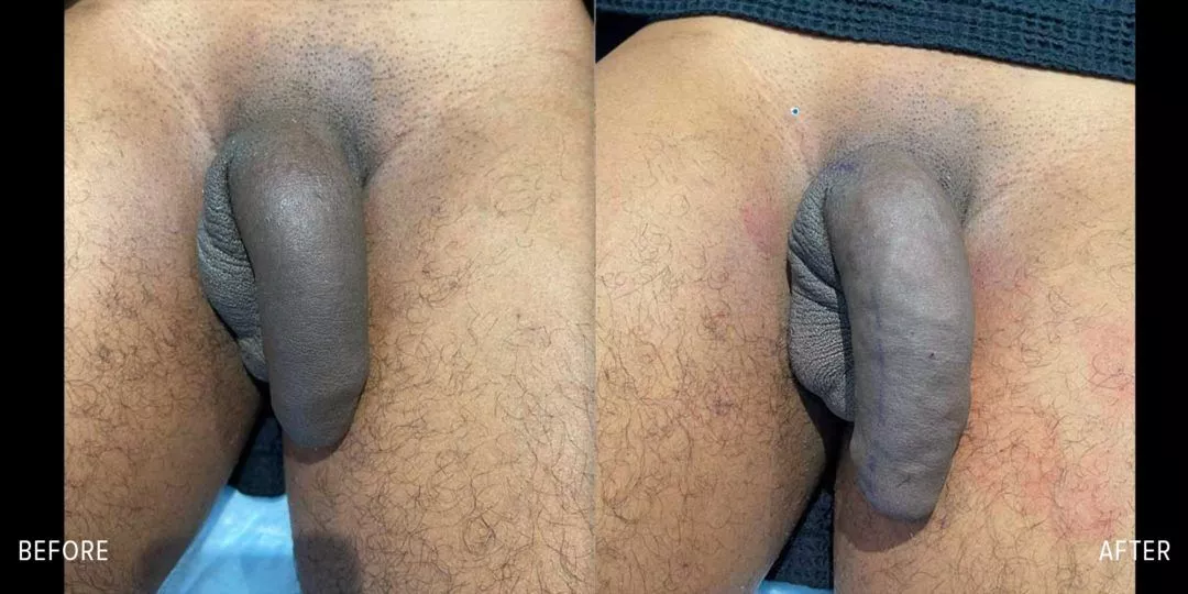 240345-1of2-1080x540 Penile Fat Transfer