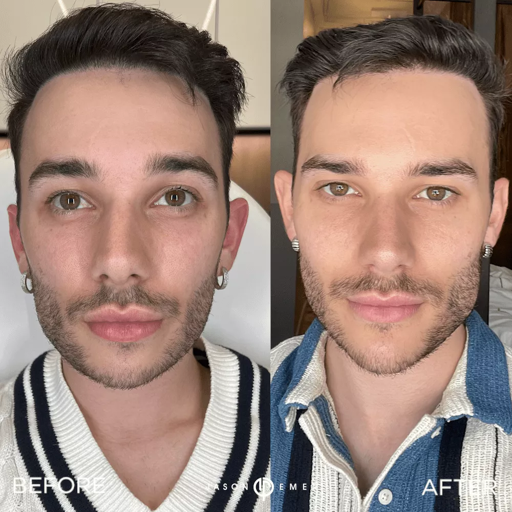facial-sculpting-male-bxa
