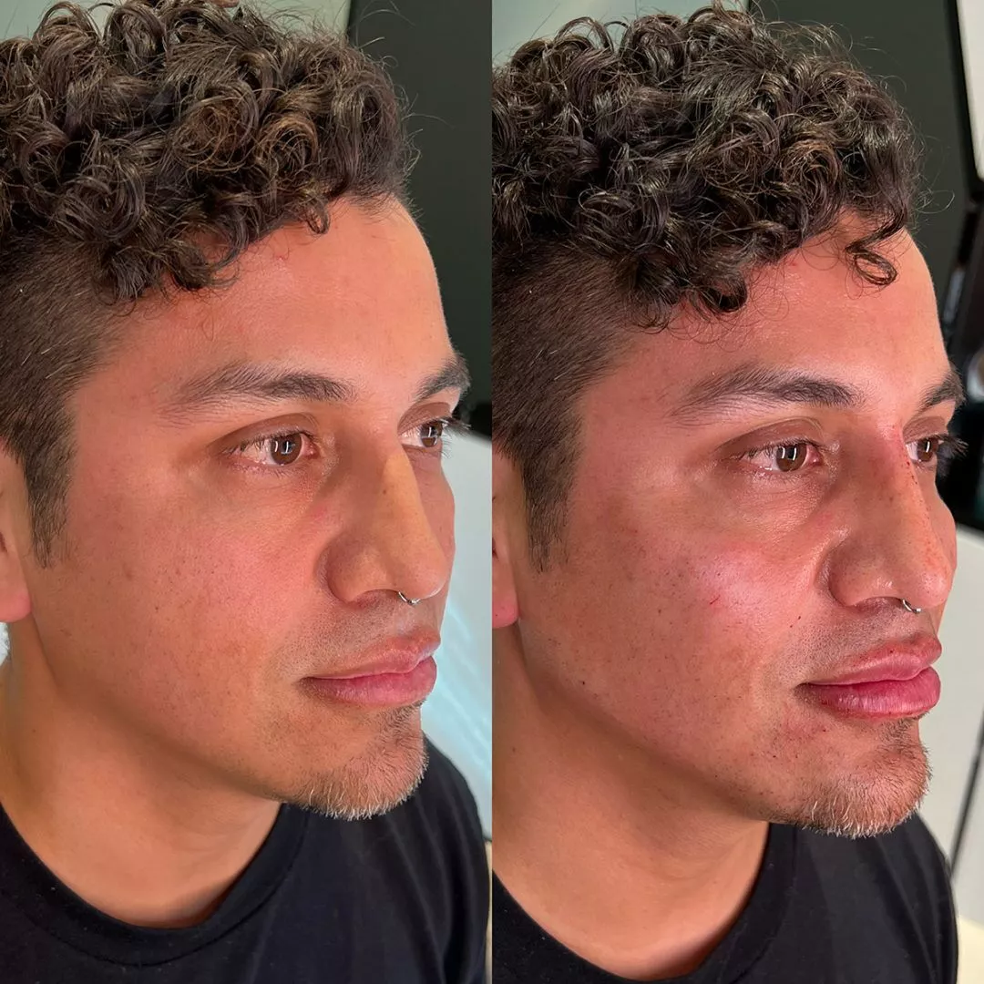 facial-sculpting-male-bxa-1080x1080